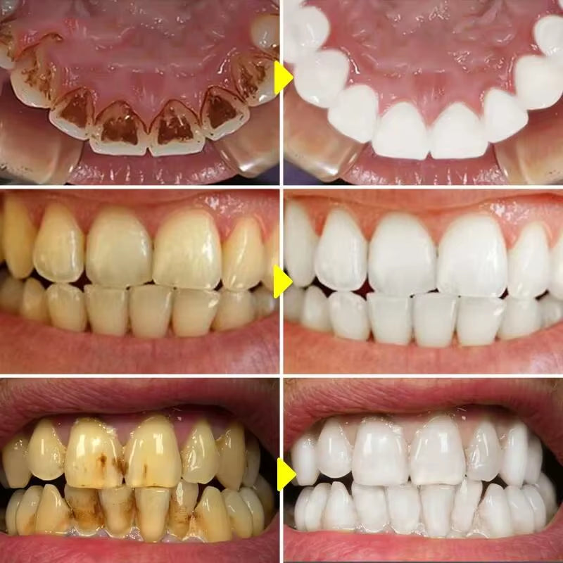 5-Day Teeth Whitening Powder — Remove Plaque, Stains & Bad Breath - Gold Store Business